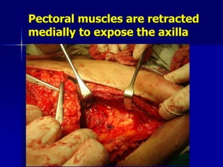 Pectoral muscles are retracted
medially to expose the axilla
 