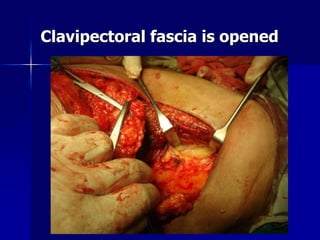 Clavipectoral fascia is opened
 