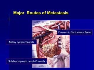 Subdiaphragmatic Lymph Channels
Channels to Contralateral Breast
Axillary Lymph Channels
Major Routes of Metastasis
 