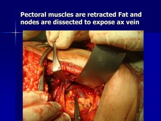 Pectoral muscles are retracted Fat and
nodes are dissected to expose ax vein
 
