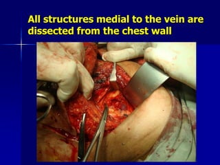 All structures medial to the vein are
dissected from the chest wall
 
