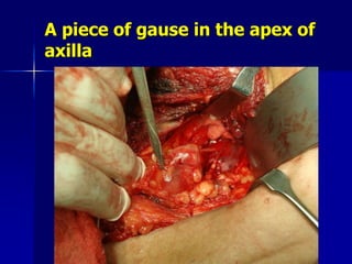 A piece of gause in the apex of
axilla
 
