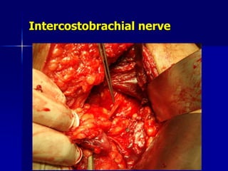 Intercostobrachial nerve
 