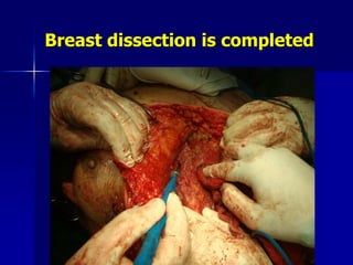 Breast dissection is completed
 