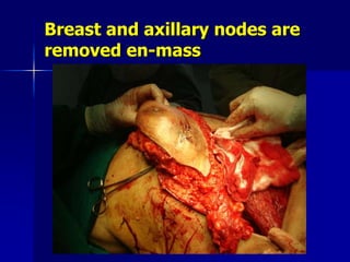 Breast and axillary nodes are
removed en-mass
 