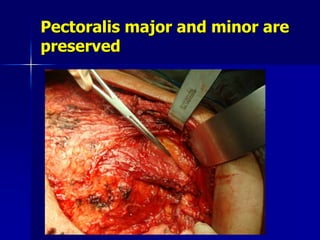 Pectoralis major and minor are
preserved
 