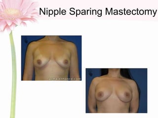 Nipple Sparing Mastectomy
 