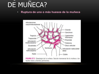DE MUÑECA?
  • Ruptura de uno o más huesos de la muñeca
 