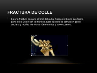 FRACTURA DE COLLE
•   Es una fractura cercana al final del radio, hueso del brazo que forma
    parte de la unión con la muñeca. Esta fractura es común en gente
    anciana y mucho menos común en niños y adolescentes.
 