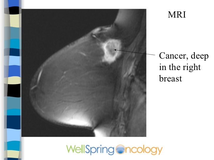 What is breast cancer with chest wall involvement?