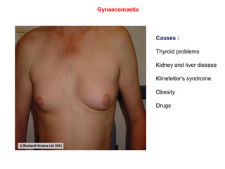 Frequency of breast
carcinoma at various sites
Palpation of axillary region
for enlarged nodes
 