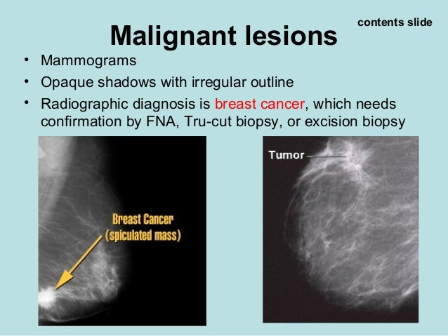 Breast