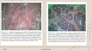 Preast Cancer Breast cancer with anatomy physiology and staging .pptx