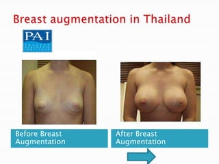 Before Breast   After Breast
Augmentation    Augmentation
 