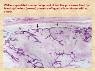 Breast benign neoplasms For MBBS | PPTX