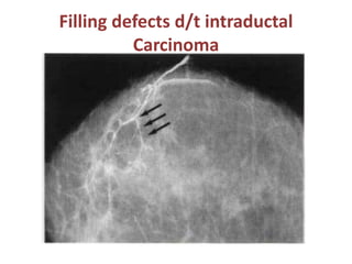 Filling defects d/t intraductal
Carcinoma
 