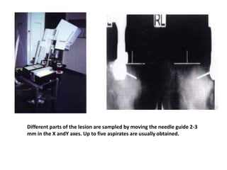 Different parts of the lesion are sampled by moving the needle guide 2-3
mm in the X andY axes. Up to five aspirates are usually obtained.
 
