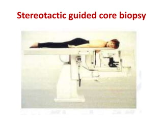 Stereotactic guided core biopsy
 