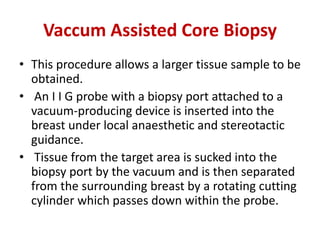 Vaccum Assisted Core Biopsy
• This procedure allows a larger tissue sample to be
obtained.
• An I I G probe with a biopsy port attached to a
vacuum-producing device is inserted into the
breast under local anaesthetic and stereotactic
guidance.
• Tissue from the target area is sucked into the
biopsy port by the vacuum and is then separated
from the surrounding breast by a rotating cutting
cylinder which passes down within the probe.
 