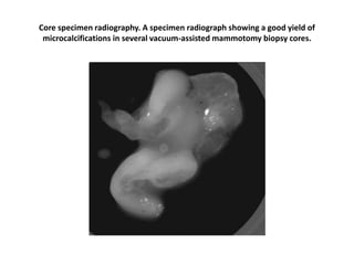 Core specimen radiography. A specimen radiograph showing a good yield of
microcalcifications in several vacuum-assisted mammotomy biopsy cores.
 
