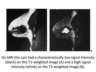 On MRI this cyst had a characteristically low signal intensity
(black) on this T1-weighted image (A) and a high signal
intensity (white) on the T2-weighted image (B).
 