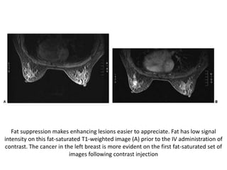 Fat suppression makes enhancing lesions easier to appreciate. Fat has low signal
intensity on this fat-saturated T1-weighted image (A) prior to the IV administration of
contrast. The cancer in the left breast is more evident on the first fat-saturated set of
images following contrast injection
 