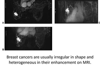 Breast cancers are usually irregular in shape and
heterogeneous in their enhancement on MRI.
 