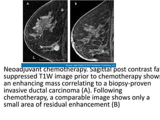 • Neoadjuvant chemotherapy. Sagittal post contrast fat
suppressed T1W image prior to chemotherapy shows
an enhancing mass correlating to a biopsy-proven
invasive ductal carcinoma (A). Following
chemotherapy, a comparable image shows only a
small area of residual enhancement (B)
 