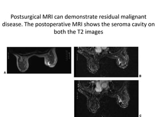 Postsurgical MRI can demonstrate residual malignant
disease. The postoperative MRI shows the seroma cavity on
both the T2 images
 