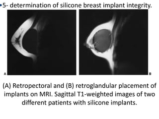(A) Retropectoral and (B) retroglandular placement of
implants on MRI. Sagittal T1-weighted images of two
different patients with silicone implants.
•5- determination of silicone breast implant integrity.
 