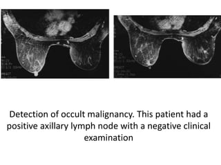 Detection of occult malignancy. This patient had a
positive axillary lymph node with a negative clinical
examination
 