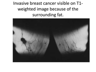 Invasive breast cancer visible on T1-
weighted image because of the
surrounding fat.
 