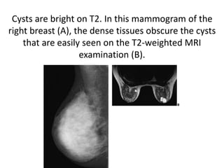 Cysts are bright on T2. In this mammogram of the
right breast (A), the dense tissues obscure the cysts
that are easily seen on the T2-weighted MRI
examination (B).
 