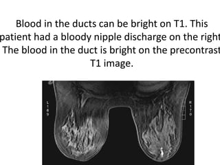 Blood in the ducts can be bright on T1. This
patient had a bloody nipple discharge on the right
The blood in the duct is bright on the precontrast
T1 image.
 