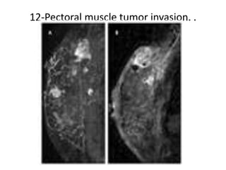 12-Pectoral muscle tumor invasion. .
 