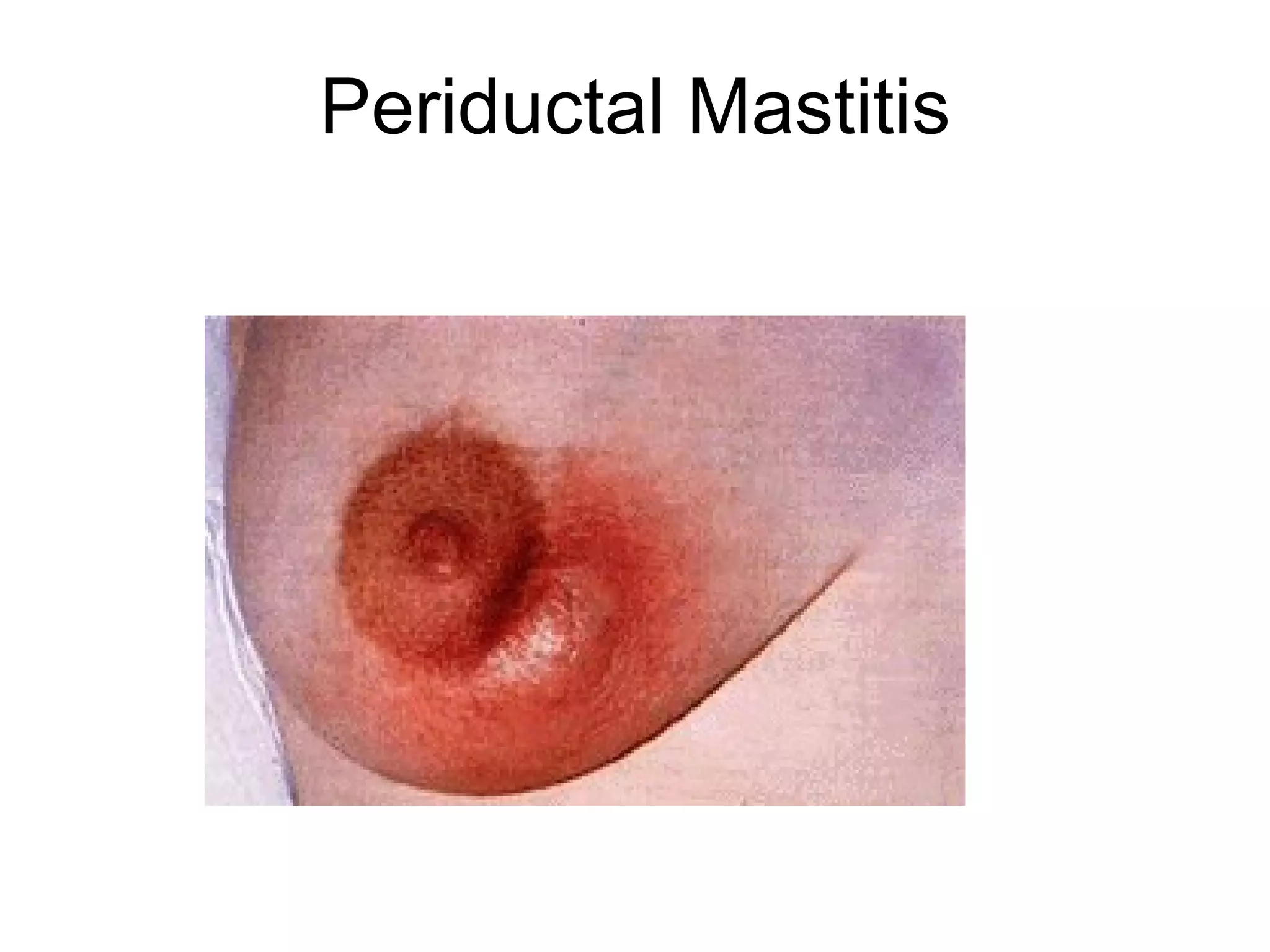 Breast Infections. RSHUSSEIN.FRCS,MD | PPT