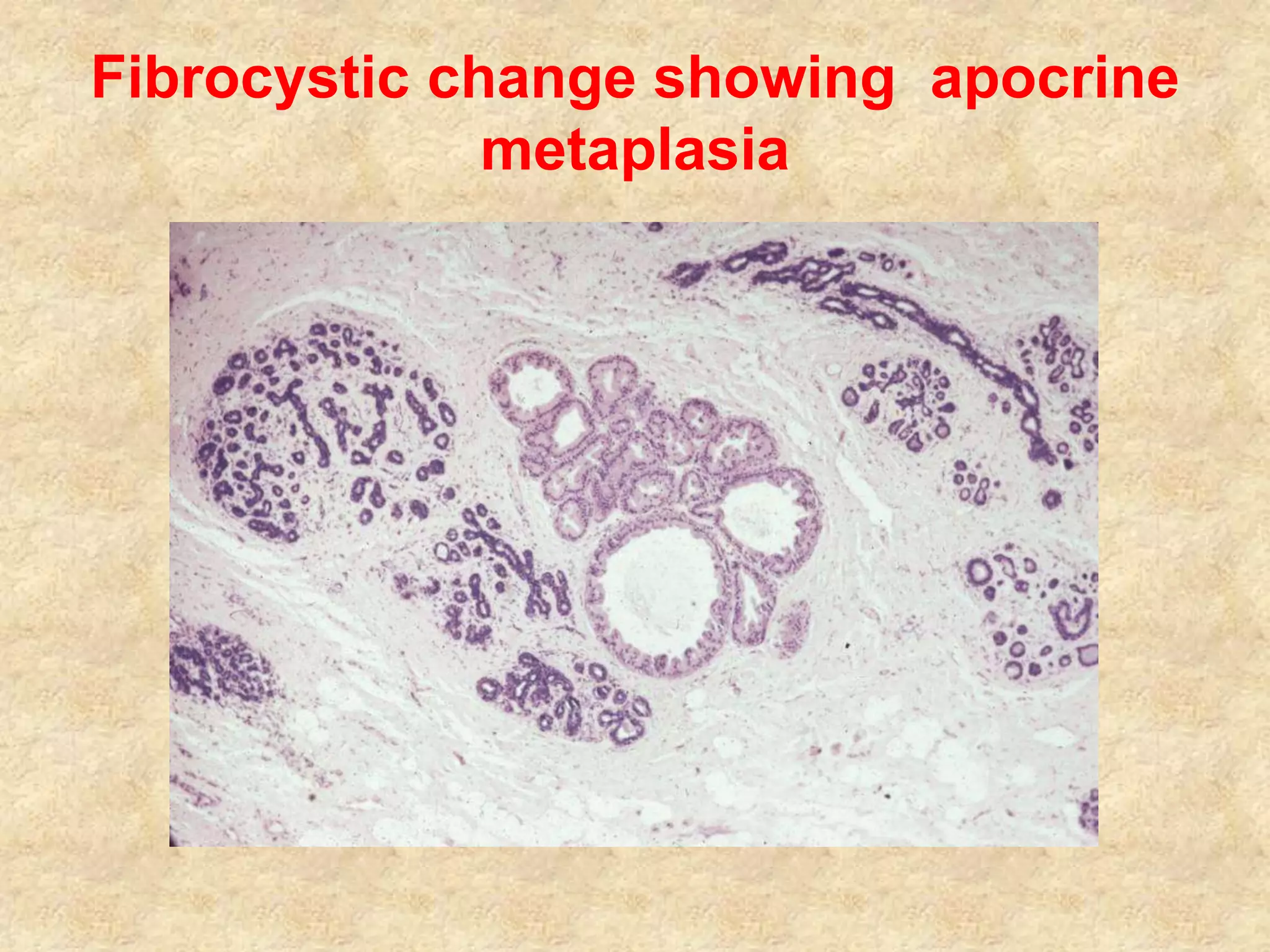 Breast inflammatory, proliferative lesions for MBBS | PPTX