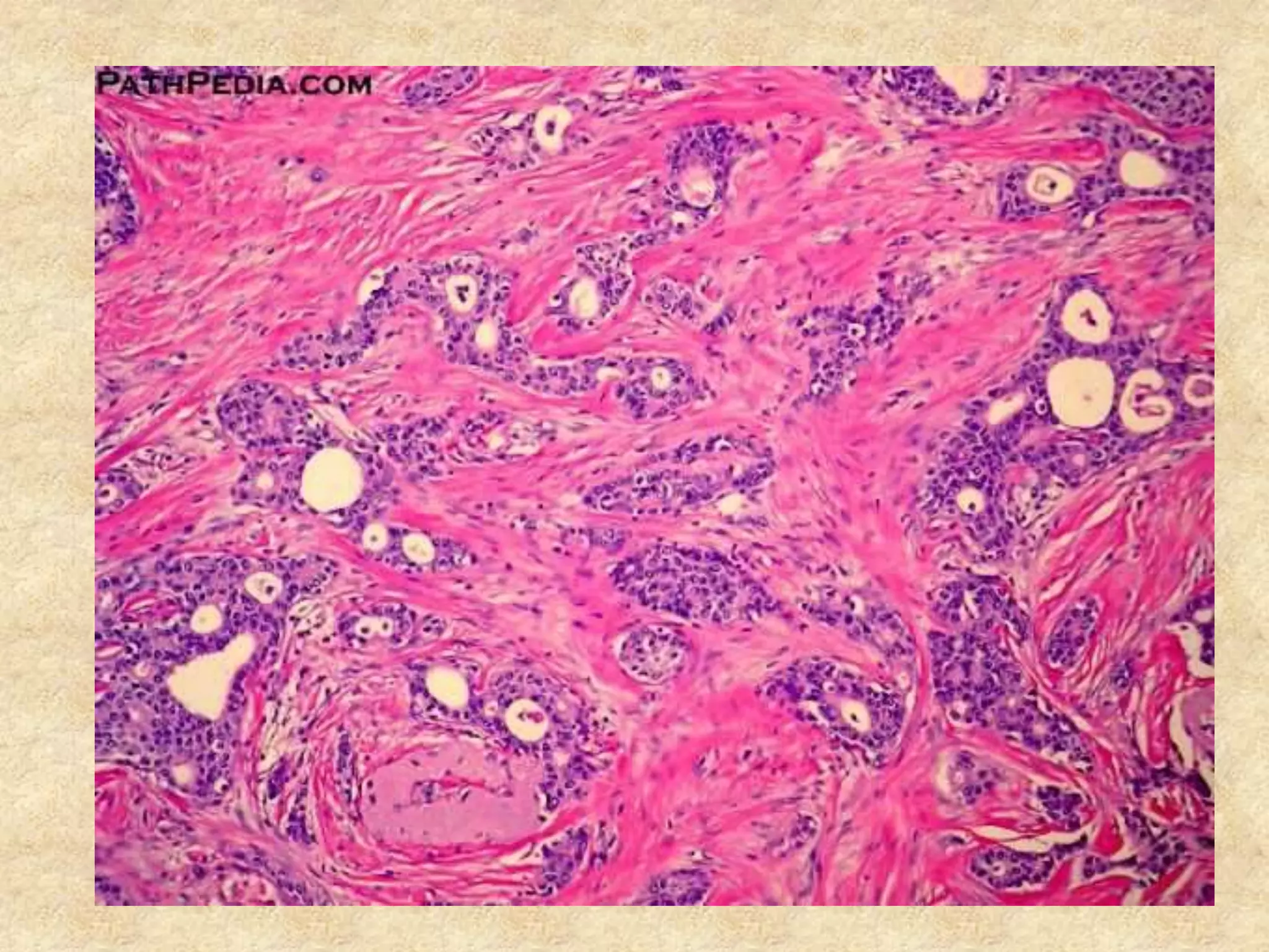 Breast malignant lesions_ MBBS | PPTX
