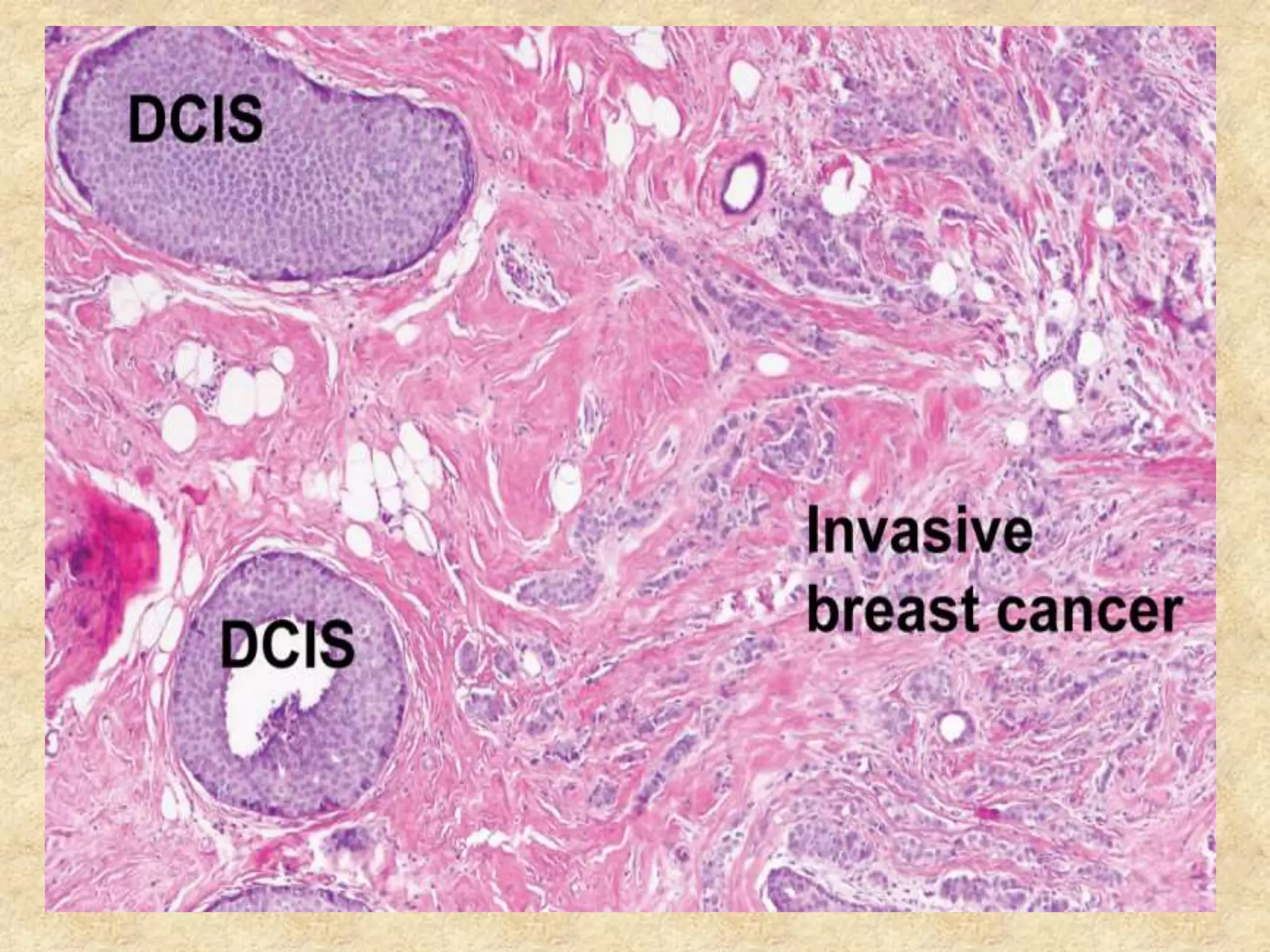 Breast malignant lesions_ MBBS | PPTX