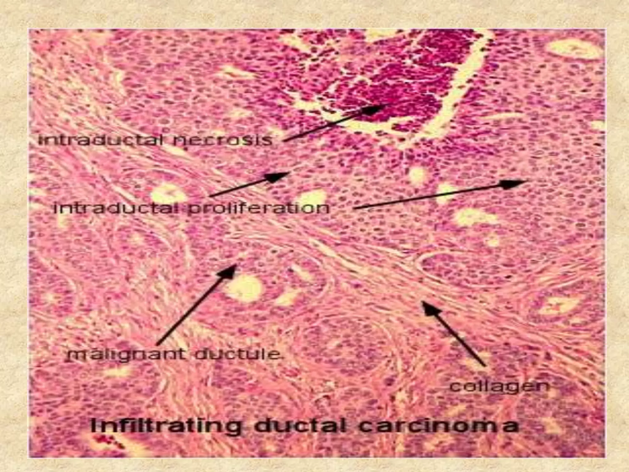 Breast malignant lesions_ MBBS | PPTX