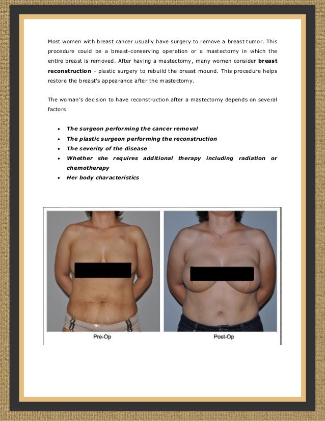 a study on breast reconstruction after mastectomy a study on breast reconstruction after mastectomy