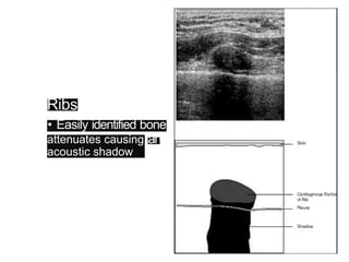 Ultrasound For Rib Example breast-ultrasound.pptx