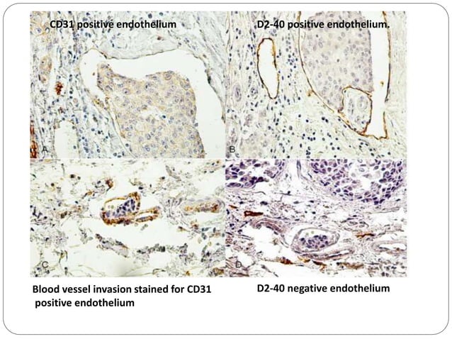 Immunohistochemistry Of Breast Lesions IHC PPTX Cancer Diseases immunohistochemistry-of-breast-lesions-ihc-pptx-cancer-diseases