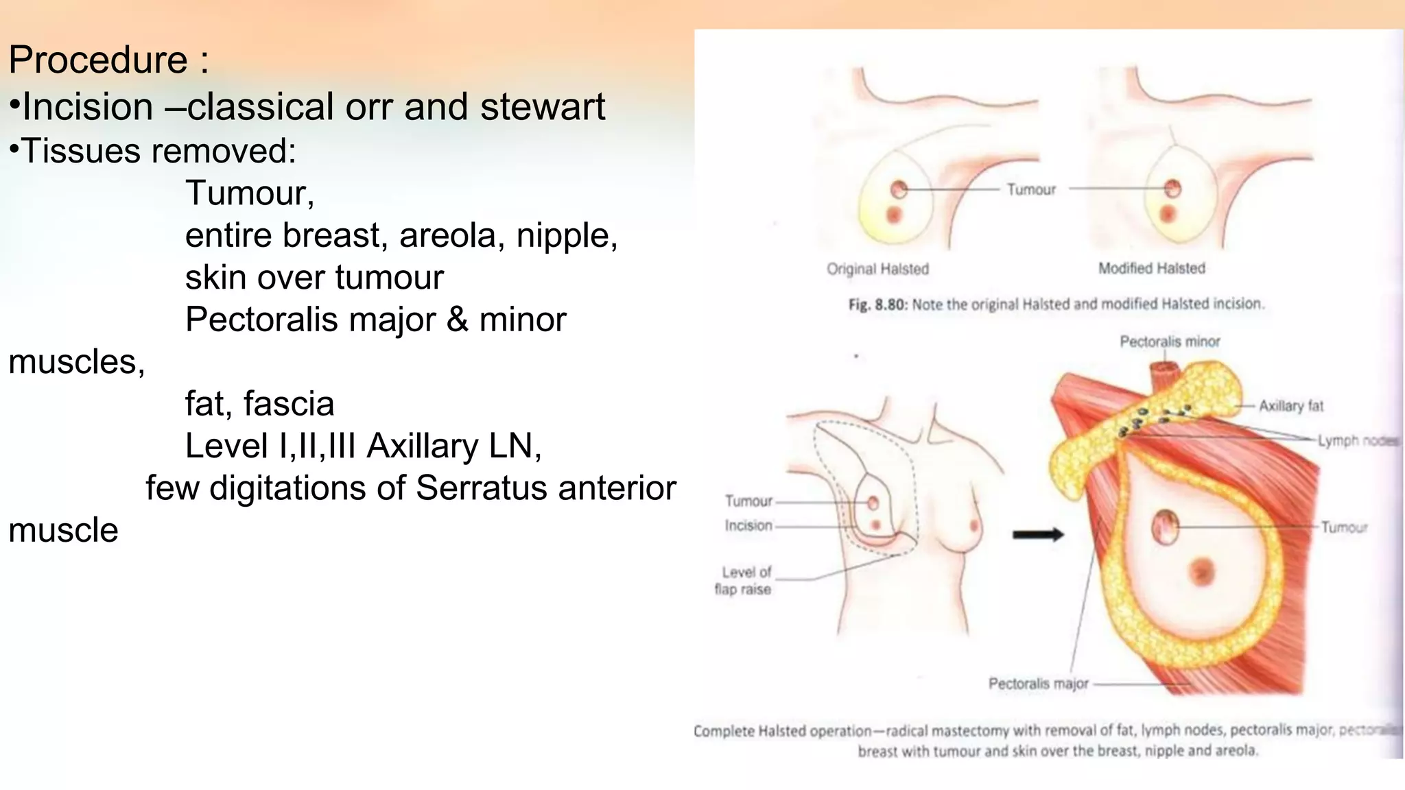 surgeries for Breast carcinoma | PPT
