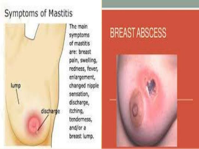 Image result for breast abscess