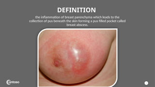 Breast Abscess; Causes to Managment.pptx