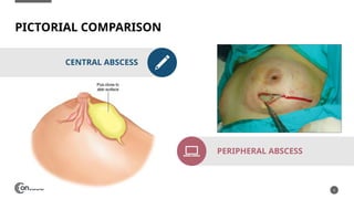 Breast Abscess; Causes to Managment.pptx