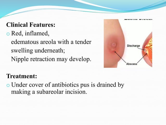 Breast abscess f .pptx | Ear, Nose and Throat Conditions | Diseases and ...