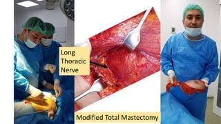 Modified Total Mastectomy
Long
Thoracic
Nerve
 