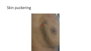 Puckered Incision BREAST ANATOMY HISTOLOGY EMBRYOLOGY.pptx